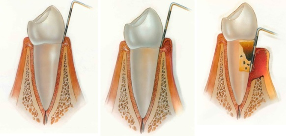 fases-periodoncia