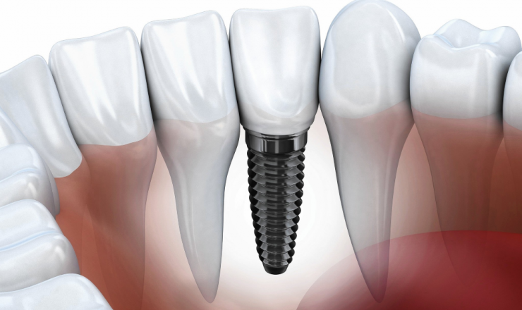 implantes-dentales